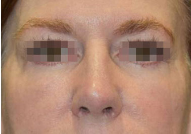 woman after brow lift in Naples