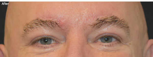 Man after brow lift in Naples