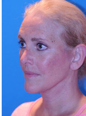 woman after brow lift in Naples