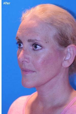 woman after brow lift in Naples