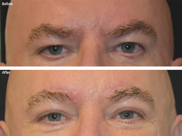 Before and After brow lift in Naples