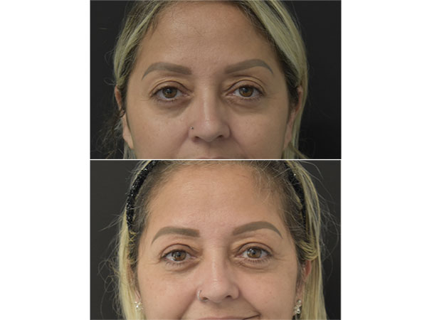 woman before and after blepharoplasty in Naples