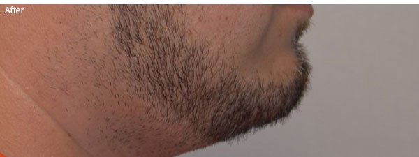 Man after chin implant in Naples