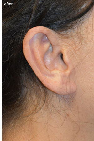 woman after earlobe surgery in Naples