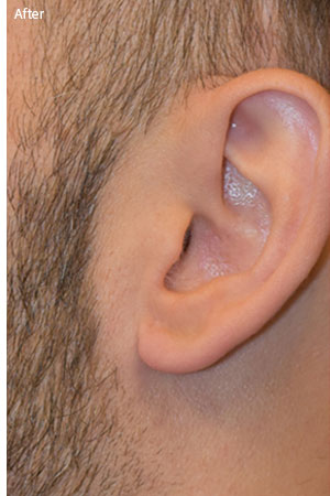 patient after earlobe surgery in Naples