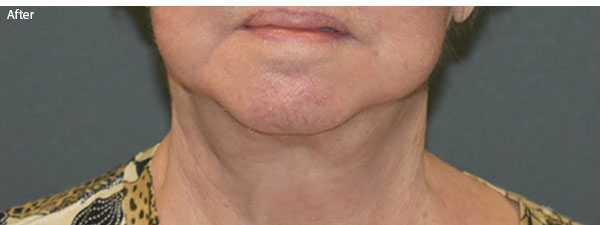 woman after neck lift in Naples