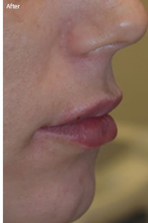 woman after lip filler in Naples