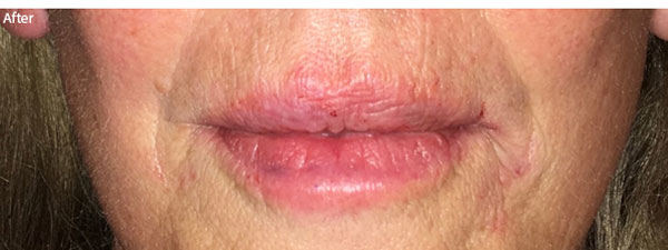 patient after lip filler in Naples