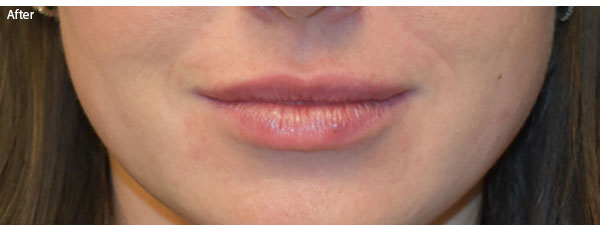 woman after lip filler on Naples
