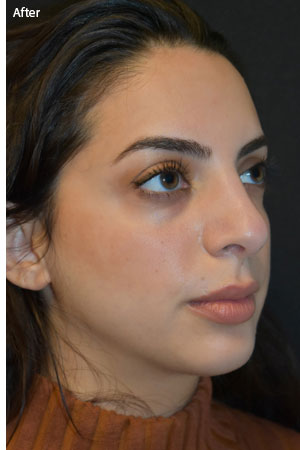 woman after rhinoplasty in Naples
