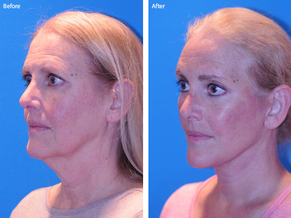 Before and After of neck lift in Naples