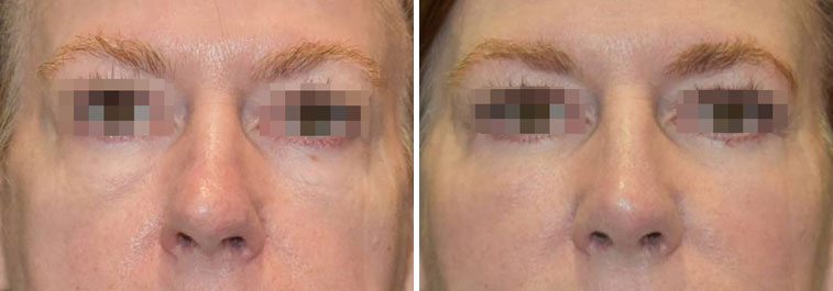 Before and After photo of facial fat transfer in Naples