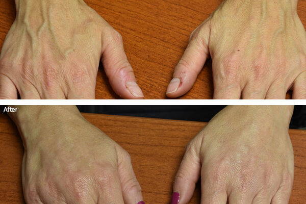 hand-filler-1