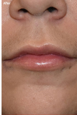 patient after lip filler in Naples