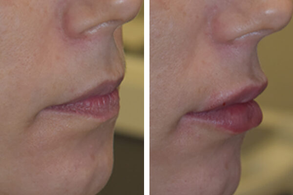 lip-filler-1