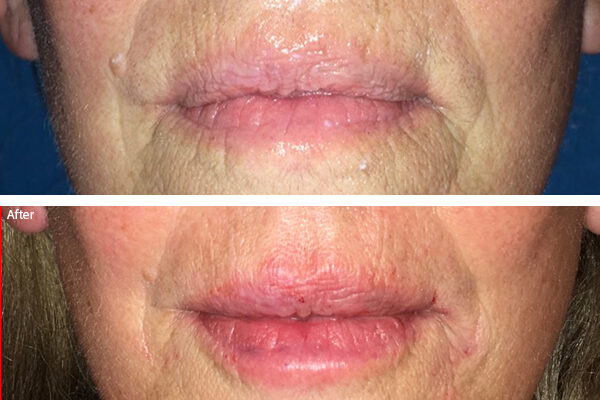 lip-filler-2