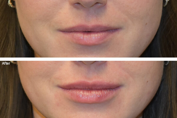 lip-filler-3
