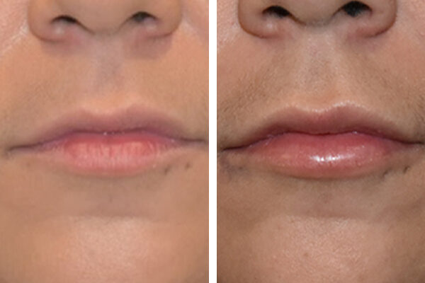 lip-filler-4a