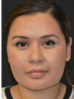 woman after neck liposuction in Naples