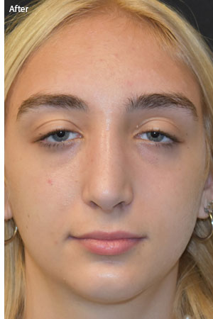 woman after rhinoplasty in Naples