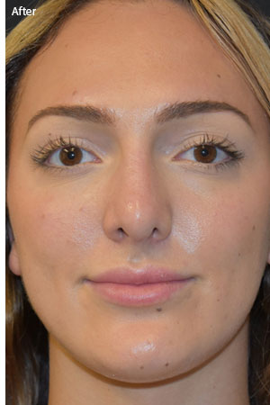 woman after Rhinoplasty in Naples