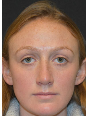 woman after rhinoplasty in Naples