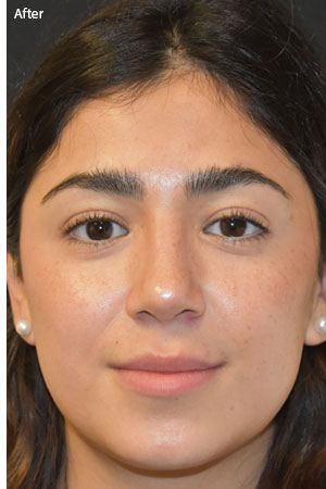 woman after rhinoplasty in Naples