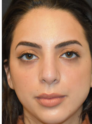 woman after Rhinoplasty in Naples