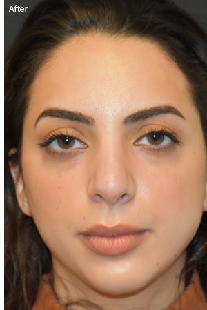 woman after Rhinoplasty in Naples