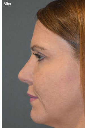 woman after rhinoplasty in Naples