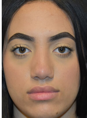 woman after rhinoplasty in Naples