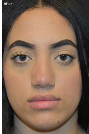 woman after rhinoplasty in Naples
