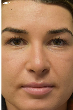 woman after rhinoplasty in Naples