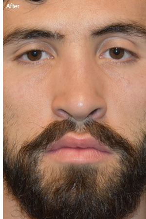 man after rhinoplasty in Naples