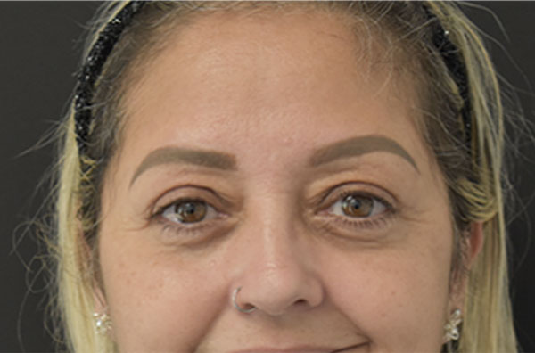 woman before blepharoplasty in Naples